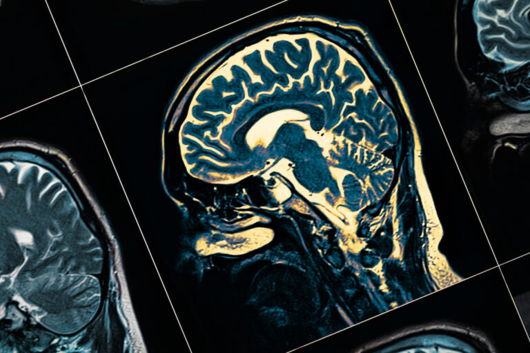 MRI of a patient's head close-up